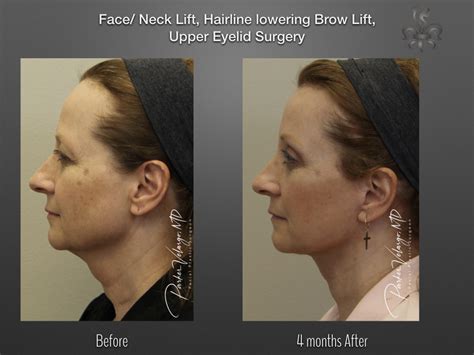 Facelift And Neck Lift Case 3852 New Orleans Premier Center For Aesthetics And Plastic Surgery