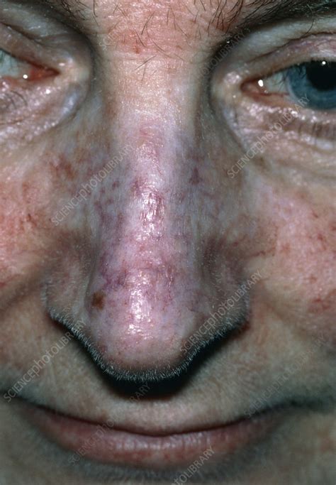 Patients Nose Affected By Lupus Erythematosus Stock Image M200