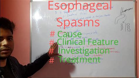 Esophageal Spasms YouTube