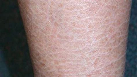 Collection Of Dark Scaly Spots On Skin Actinic Keratosis Potentially