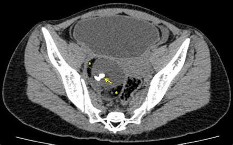 Ovarian Dermoid Presenting As Unilateral Obstructive Uropathy Bmj