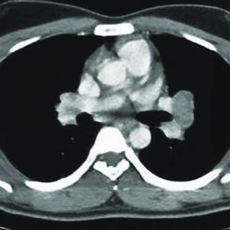 Computed Tomography Showing Mediastinal Lymph Nodes Invading The Airway