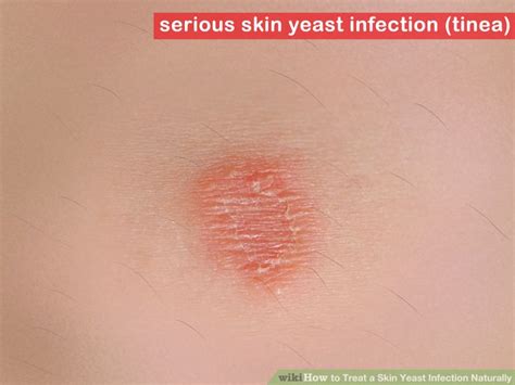 How To Treat A Skin Yeast Infection Naturally How To Do It