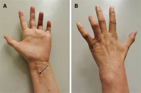 Ulnar Nerve Injury Associated With Displaced Distal R Vrogue Co