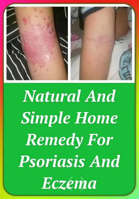Natural And Simple Home Remedy For Psoriasis And Eczema Home Remedies