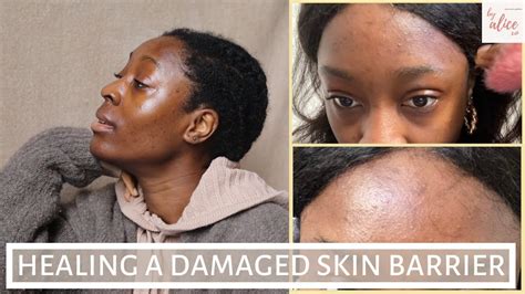 I Damaged My Skin Barrier Heres How I Fixed It Repairing My