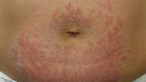 Discover Rash On The Abdomen Check This Article