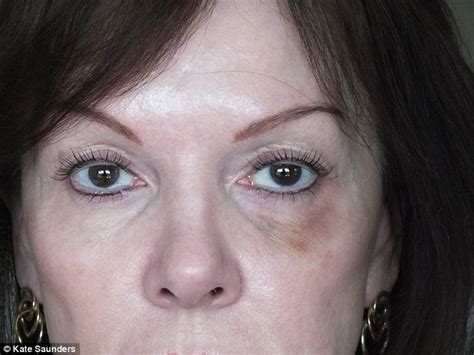 Northumberland Woman Left With A Black Eye After Botched £350 Botox