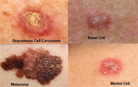 Skin Cancer Types Most Common Skin Cancer SunskinClinic