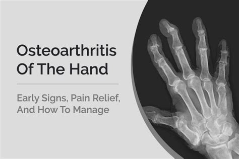 Hand Arthritis Early Signs Pain Relief And How To Manage St Albert