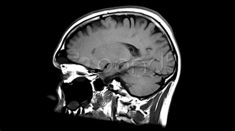 Brain Scan Side View Stock Footage,#Side#Scan#Brain#Footage | Brain scan, Mri brain, Brain