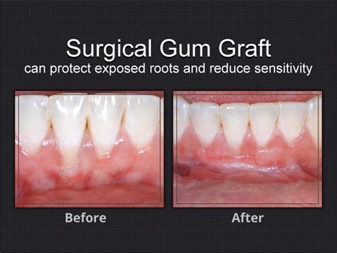 Gum Graft Surgery Before And After Pictures