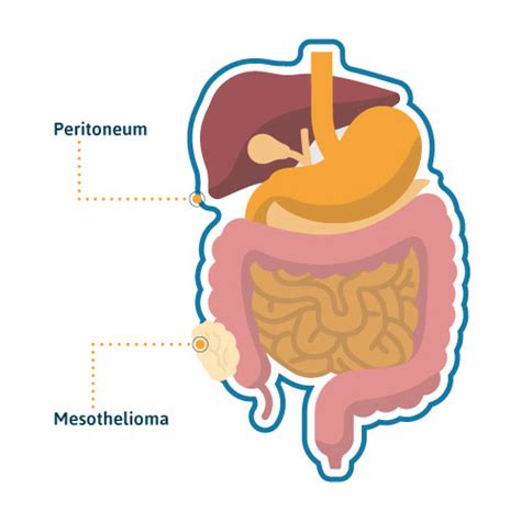 We offer treatment and prognosis assistance. Peritoneal Mesothelioma: Causes, Treatment & Survival Rates
