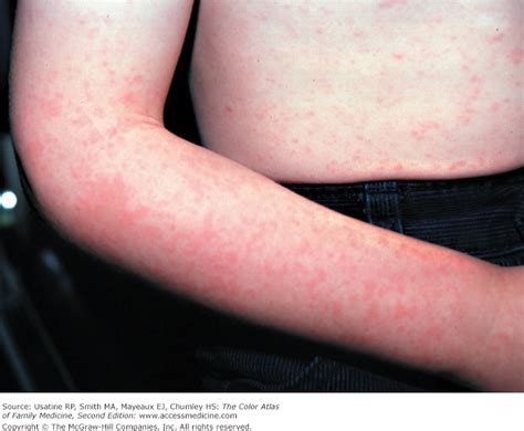 Pictures Of Fifths Disease Rash On Arms Picturemeta