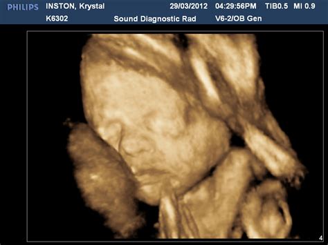Sam And Krystal 29 Weeks 3d Ultrasound