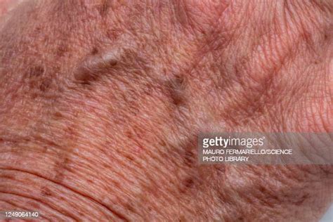 Old Age Spots On Skin Stock Fotos Und Bilder Getty Images
