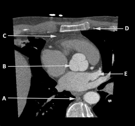 Computed Tomography Through The Aortic Root The Bmj
