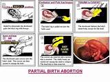 How Do Doctors Perform An Abortion Photos