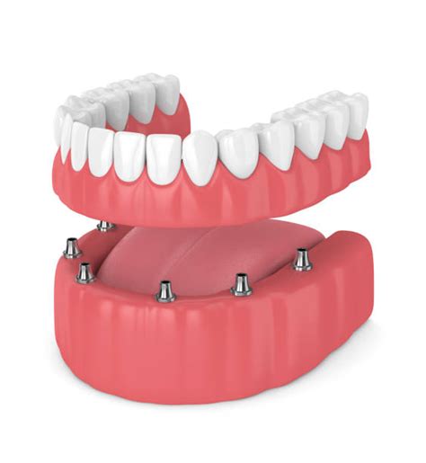 22100 Implant Denture Stock Photos Pictures And Royalty Free Images