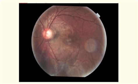 Clinical Picture Of The Left Eye Fundus Where You Can See Macular