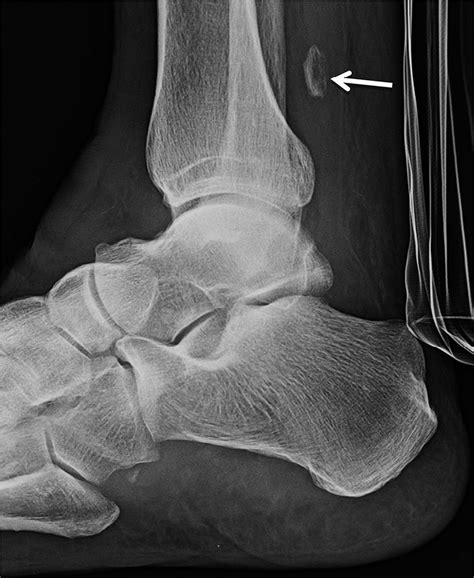 Lateral Radiograph Of The Right Foot Following Trauma X Ray Shows The