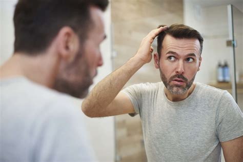 Receding Hairline Symptoms Causes And Treatments