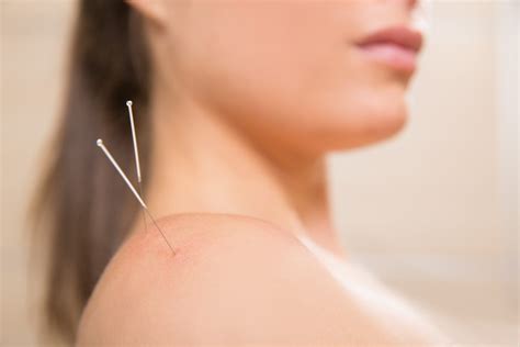 The Benefits Of Acupuncture Treatment Physio In Ottawa