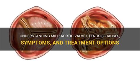 Understanding Mild Aortic Valve Stenosis Causes Symptoms And