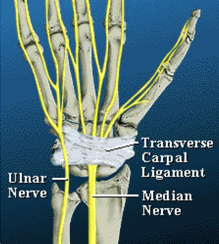 Median Nerve Entrapment Wrist Flashcards Quizlet