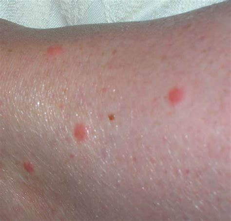 How To Take Action Against Bedbug Bites Bed Bug Control Toronto