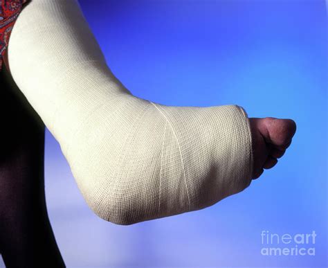 plaster cast on the broken leg of a woman photograph by simon fraser science photo library