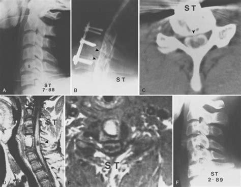 Late Decompression Of Patients With Spinal Cord Injury