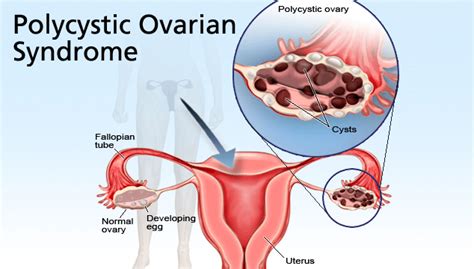 This can lead to elevated blood symptoms of pcos may begin shortly after puberty, but can also develop during the later teen years. PCOS Problem In Females And Its Treatment
