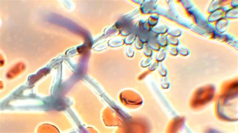 Fungal Infection Hybrid Medical Animation