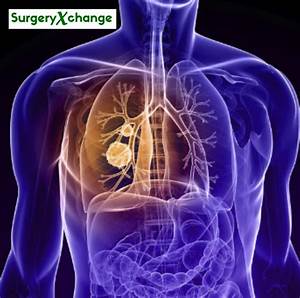 lung cancer - SurgeryXchange Lung Cancer  