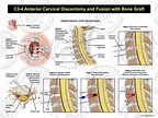 C3-4 Anterior Cervical Discectomy and Fusion with Bone Graft