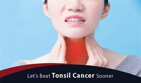 Tonsil Cancer Is It Common How Common Is Tonsil Cancer Cancer