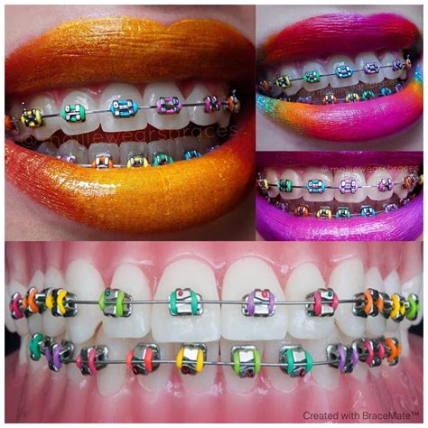 colourful braces colours braces colors cute braces cute braces colors