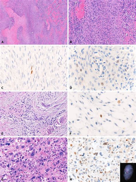 Mdm2 In Osteosarcomas An Intermediate Grade Predominantly Fibroblastic Download Scientific