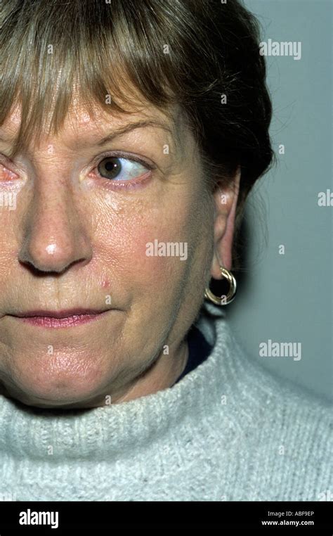 Parotid Swelling Due To Sjogrens Syndrome Stock Photo 12876477 Alamy