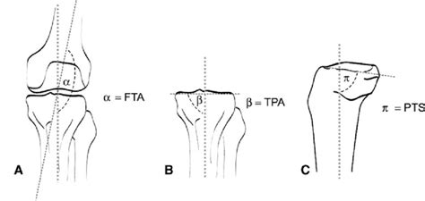 A C Preoperative Radiographic Measurements Of A Femorotibial Angle