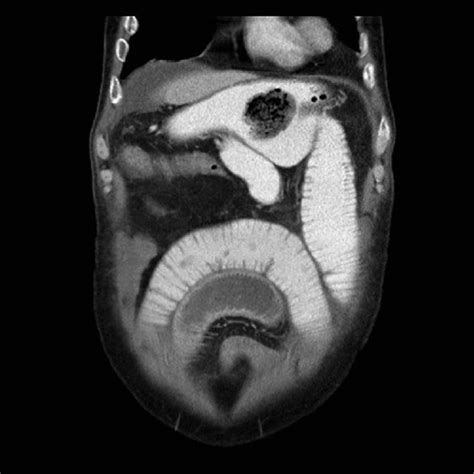 Sagittal Ct Scan View Showing Foreign Bodies In The Stomach And The
