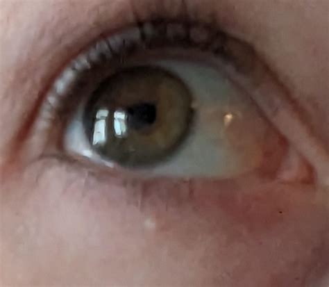Ive Had This White Spot Under My Eye For Months And It Wont Go Away