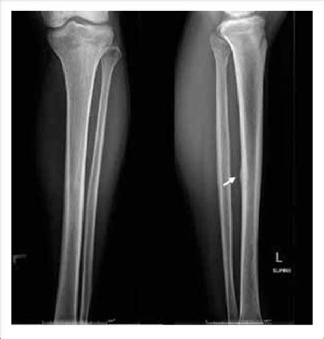 resonancia tibial posterior inflamacion porn sex picture