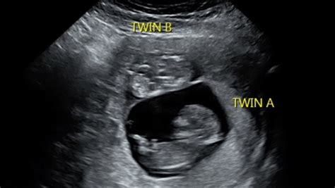 Twin B No Fluid 14 Weeks Babycenter