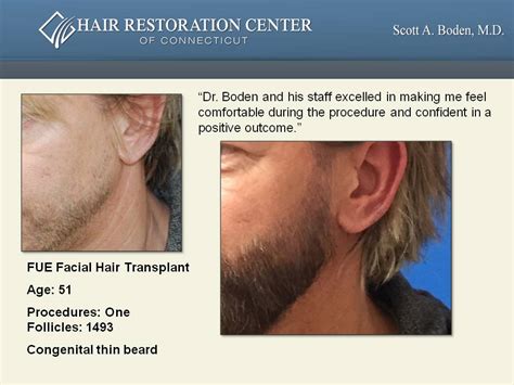 Artius offers the best facial hair transplant. Facial Hair Transplant | Hair Restoration | Hartford, CT
