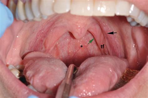 9 Oral Mucosa And Mucosal Sensation Pocket Dentistry