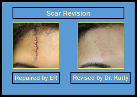 Scar Revision Surgery Scarrevision Plasticsurgery
