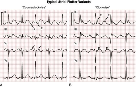 Supraventricular Arrhythmias Part Ii Atrial Flutter And Atrial