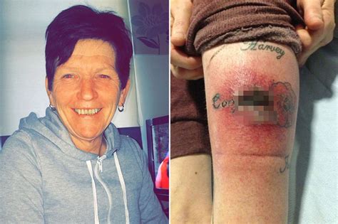 Gran Left With Gruesome Gaping Hole In Leg After Tattoo Becomes